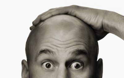 Alopecia e diradamento capillifero